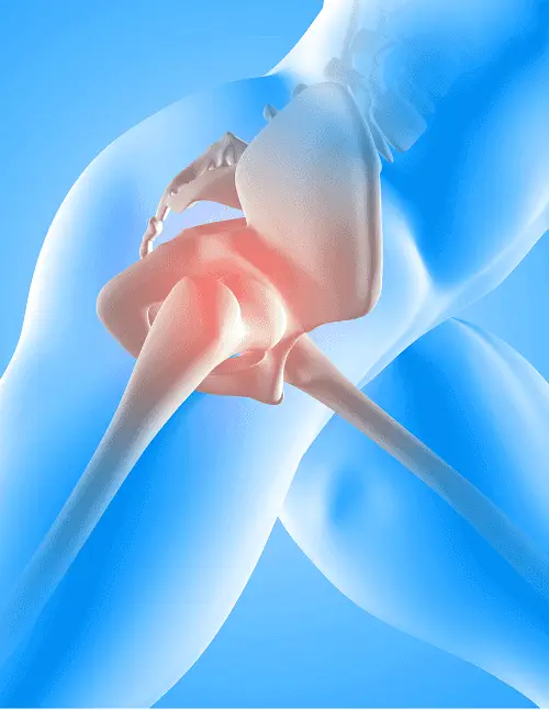 Artroplastia de Cadera