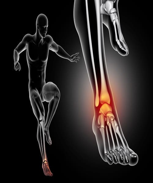 Infiltración de fascitis plantar